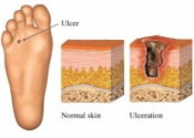 Diabetes Foot Infections