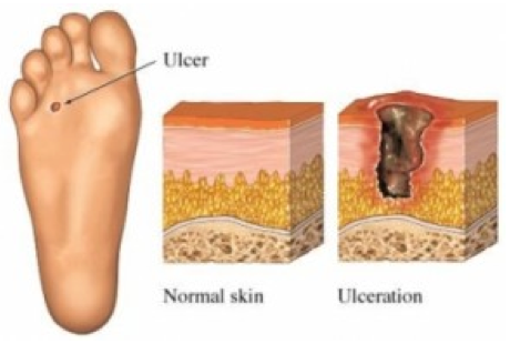 Diabetes Foot Infections